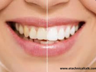 Is teeth whitening safe