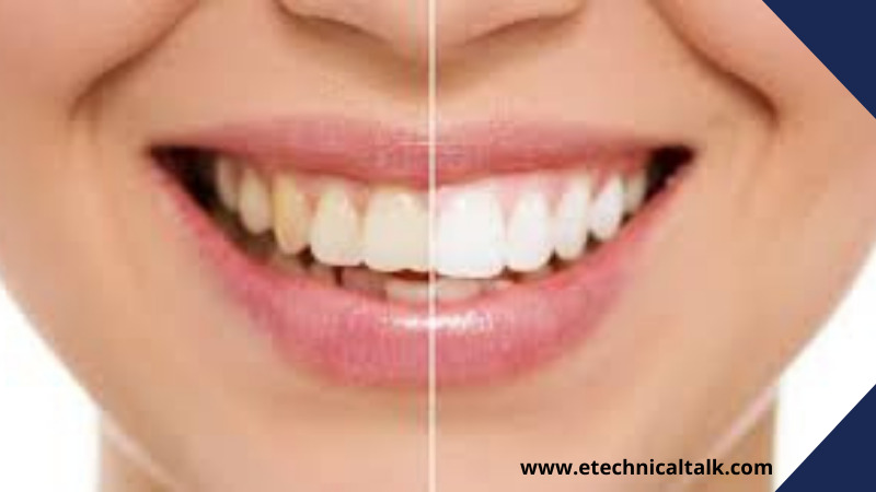 Is teeth whitening safe