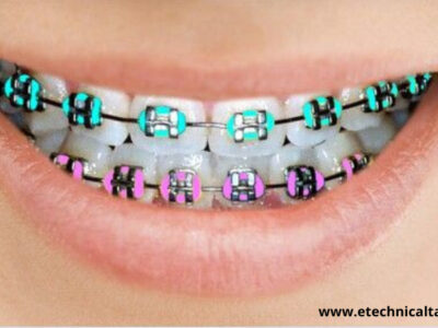 Cute color braces