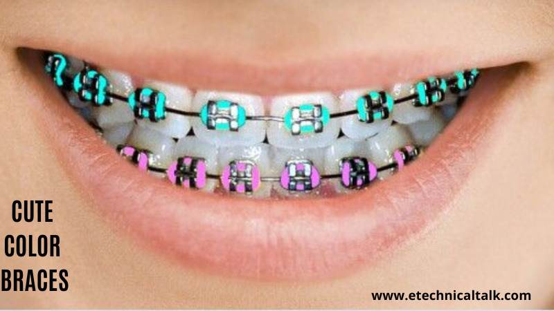 Cute color braces
